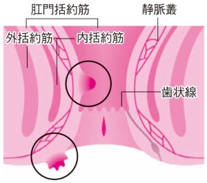 いぼ痔のイメージ図