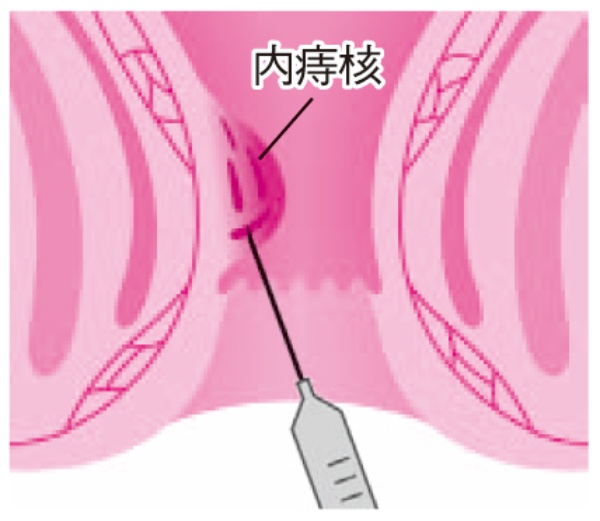 痔 女子高生 いぼ痔や切れ痔は治せる 切らずに済む日帰り手術も (2ページ目):日経xwoman