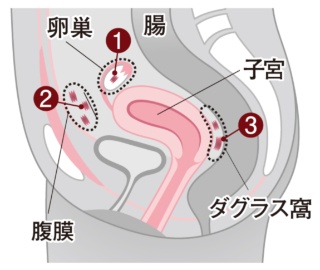 子宮内膜症のイメージ図
