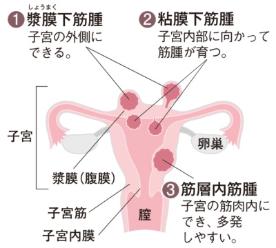 子宮筋腫のイメージ図