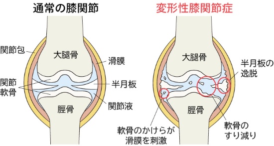 図1：膝関節の構造と変形性膝関節症