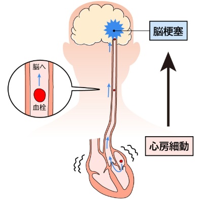 心房細動は脳梗塞(心原性脳塞栓症)の原因に