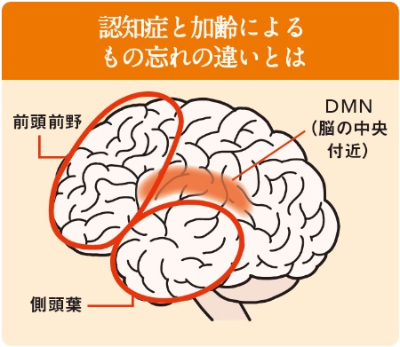 アルツハイマー型認知症は、脳の萎縮やアミロイドβの蓄積が通常より早い病気。通常の加齢では、脳萎縮やアミロイドβの蓄積は前頭前野と分散系ネットワークで活性化する脳の中央付近（DMN）から始まるのに対し、アルツハイマー病患者の脳では側頭葉にも早くから変化が表れることから、ここに何かしらの原因があると考えられているという。