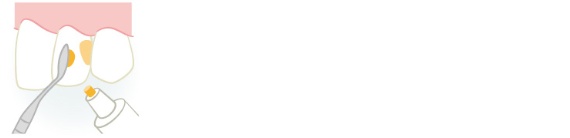 <span class="bgColShadeA bgColYellow fontSizeM textColBlack">レジン充填</span>