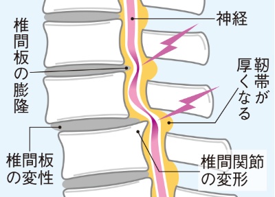 【脊柱管が狭窄したタイプ】