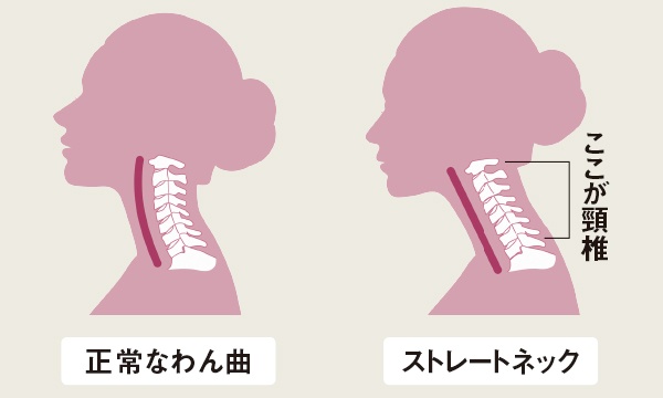 本来は軽く前わんしている頸椎が真っすぐになった状態を「ストレートネック」という。前わんが失われると頭が前に出て首に多大な負担が。「頸椎が変形してしまうと改善は難しいが、筋肉のこわばりによるストレートネックは首トレで回復が可能」（竹谷内さん）。（イラスト／PIXTA）