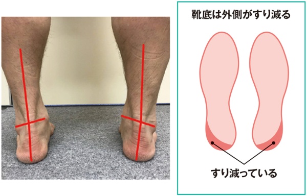 靴底でわかる かかと のゆがみ 体幹にまで影響 3ページ目 日経xwoman 靴底でわかる かかと のゆがみ 体幹にまで影響 3ページ目 日経xwoman