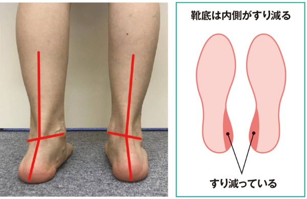 靴底でわかる かかと のゆがみ 体幹にまで影響 3ページ目 日経xwoman 靴底でわかる かかと のゆがみ 体幹にまで影響 3ページ目 日経xwoman