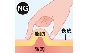 ・皮膚表面だけをつまんだり、逆に筋肉までつまんでしまうと、くっついてしまった皮膚と筋肉の接合をうまくはがすことができない