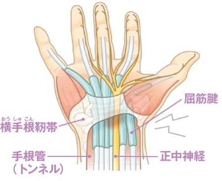 手首のところにあるトンネル状の手根管の中は、1本の正中神経と、指を動かす9本の屈筋腱が、滑膜に覆われた腱鞘を伴い、走行している。指の使い過ぎや女性ホルモンの影響などで滑膜が厚くなると神経が圧迫されてしびれなどの症状が生じる