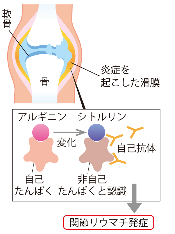 関節リウマチはたんぱく質の変化が原因？