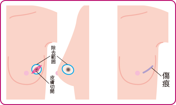 楽天市場】乳がん 術後ブラ パット 乳癌 シリコンブラ 全摘 左右
