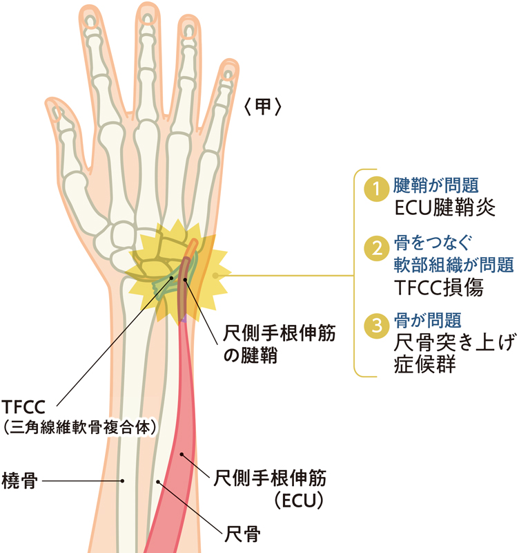 手をつくと「手首」が痛い…小指側の腱鞘炎 原因と対策は：日経xwoman