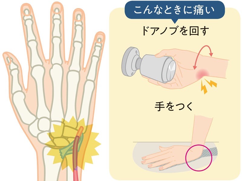 手首の小指側が痛い 腱鞘炎以外で考えられる原因は:日経xwoman