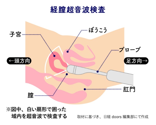 20代から増える子宮がん 働き盛りこそ子宮を守る対策を (4ページ目):日経xwoman