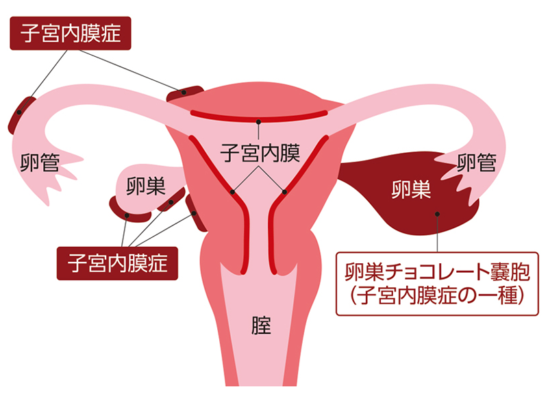 受験にも影響。10代の生理痛も早めに治療を［PR］ （2ページ目）：日経