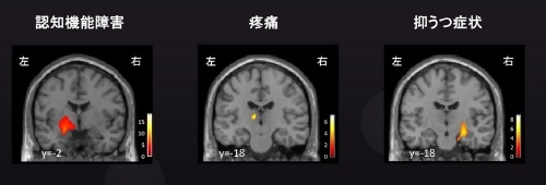 ◆PET-CT検査で明らかになった脳内神経炎症