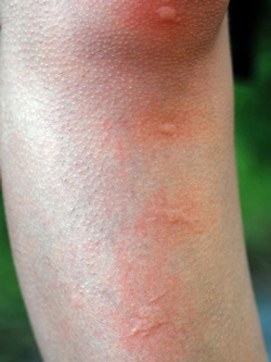 蚊に刺されたあとのあのかゆみ…どう対処すれば良いのでしょうか？（©cristi180884-123rf）