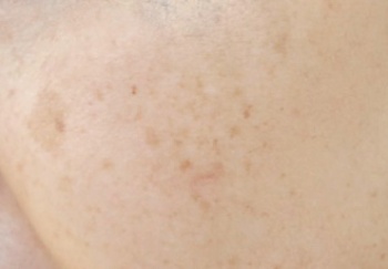 左頬の上部にできたシミの症例。「丸くくっきりした形の老人性色素斑と、薄茶色の肝斑が混在している。美容皮膚科ではまず内服薬などで肝斑を治療し、その後シミを取るレーザー治療などを行う」（佐藤院長）