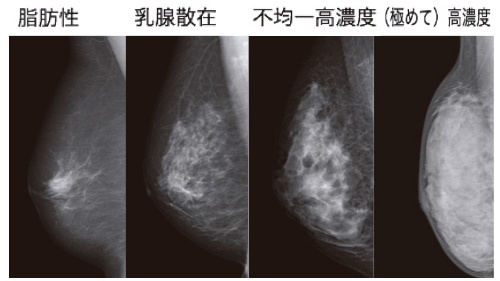 マンモグラフィの画像は乳腺の濃度によって4段階に分けられる。乳腺濃度が高くなるほど白く写り、がんを見つけにくくなる。（画像提供：NPO法人乳がん画像診断ネットワーク）