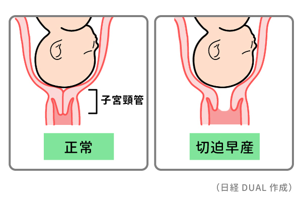 働く妊婦が知っておくべき早産リスク （2ページ目）：日経xwoman