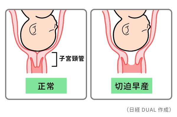 働く妊婦が知っておくべき早産リスク 2ページ目 日経xwoman 働く妊婦が知っておくべき早産リスク 2ページ目 日経xwoman