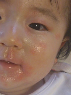 乳製品を食べた5分後に口の周りから顔全体に赤みや腫れが広がった赤ちゃん