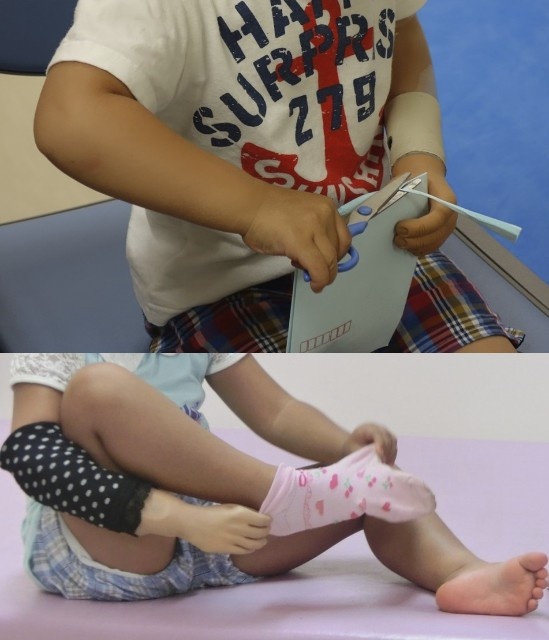 義手を着けることで子ども達は「はさみを使う」「靴下をはく」といった友達と同じことを両手で練習していく（写真提供：東京大学医学部附属病院リハビリテーション部・科）