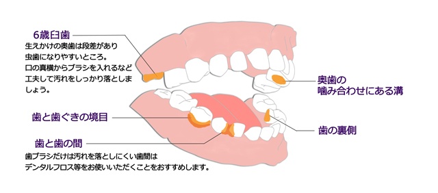 6歳臼歯や奥歯のかみ合わせにある溝、歯と歯茎の境目、歯の裏側、歯と歯の間は磨き残しやすいところ。特に気を付けて磨く必要がある